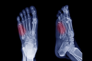 Symptoms of a Jones Fractures