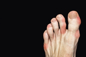 Signs and Causes of Gout