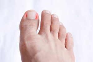 Older People May Be Prone to Getting Ingrown Toenails