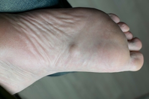 Definition of a Plantar Fibroma