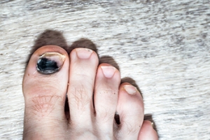Causes and Prevention of Black Toenails