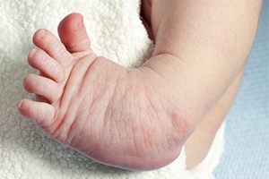 Clubfoot Symptoms