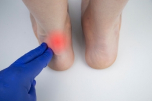 Pain and Burning in the Achilles Tendon