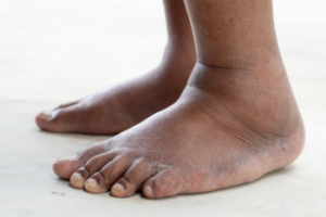 Causes and Dangers of Swollen Feet