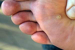 Causes and Types of Plantar Warts