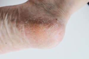 What Causes Cracked Heels?